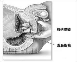 前列腺检查