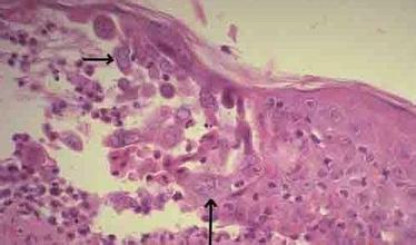 单纯疱疹病毒性脑炎