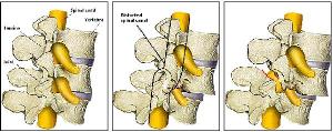 腰椎峡部裂(lumbar spondylolysis)为腰椎一侧或两侧椎弓上下关节突