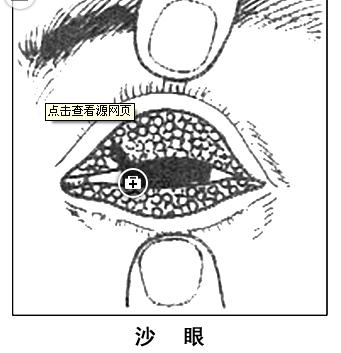 新生儿淋菌性结膜炎 新闻 正文 沙眼结膜