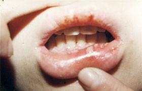 小儿口腔溃疡反反复复的发作,医学上称其为"复发性小儿口腔溃疡".