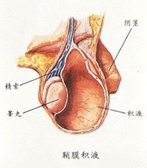 小儿鞘膜积液