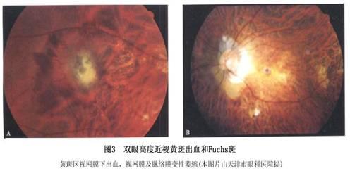 变性近视脉络膜萎缩