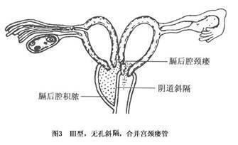 阴道斜隔隔膜起于两个宫颈之间,向远侧端偏离中线斜行,与阴道外侧壁