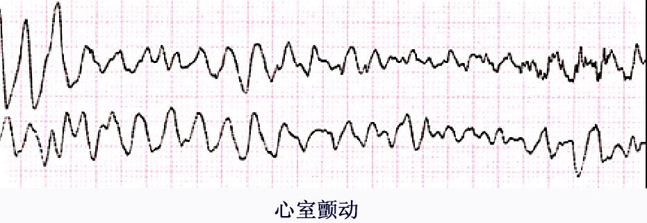 心室颤动心电图特