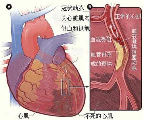 急性心肌梗死