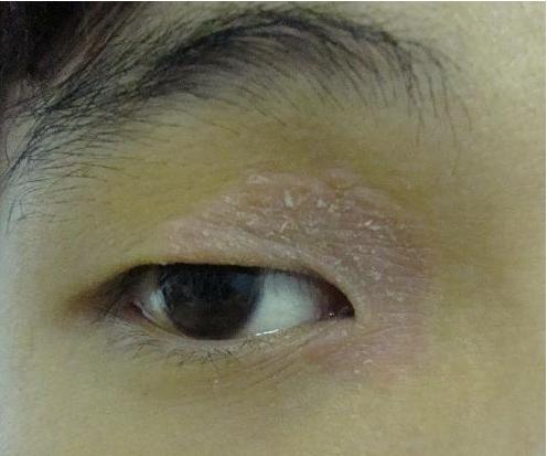 眼睑出血眼睑皮肤小点状出血可见于败血症或出血性体质者,为全身性