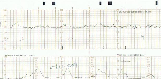 胎心监护+-+搜狗百科