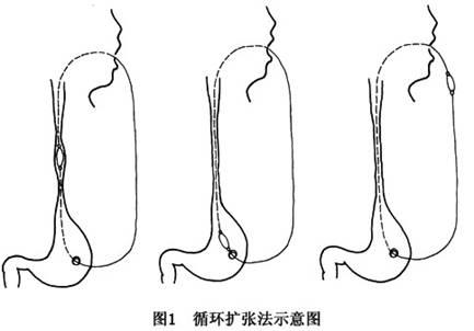 腐蚀性食管灼伤