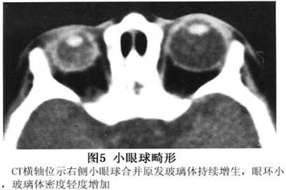 先天性小眼球合并眼眶囊肿