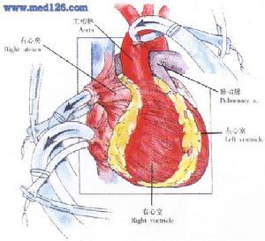 大血管错位,又称大血管转位,系主动脉与肺动脉在解剖上互换位置,形成