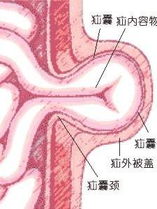 难复性疝