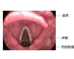 声带麻痹