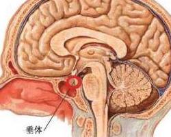 生长激素分泌过多