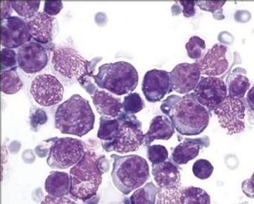 小淋巴细胞瘤是非霍奇金淋巴瘤吗 0