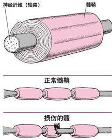 多发性硬化症 搜狗百科