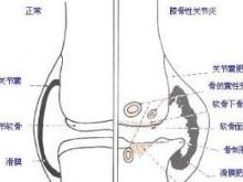 膝盖滑膜炎的症状表现怎么治疗 0