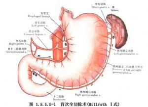 近端胃部分切除术行胃食管吻合