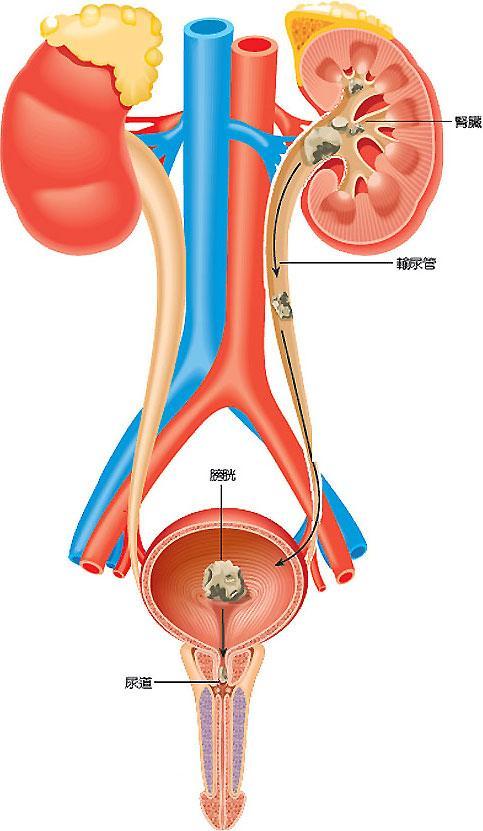 膀胱与尿道结石