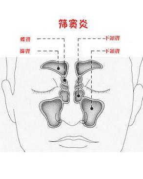 筛窦炎