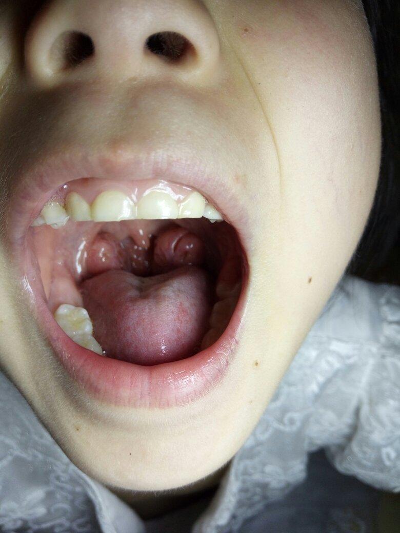 咽扁桃体是长在人的咽喉(是人体连接口腔,鼻腔与食道和喉咙的管道)靠