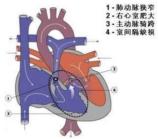 肺动脉口狭窄