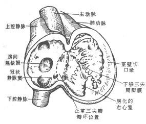 三尖瓣返流