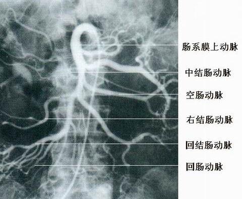 肠系膜上动脉血栓形成