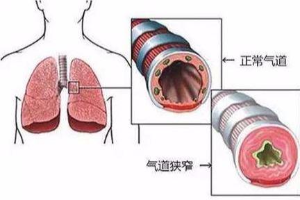 气管狭窄