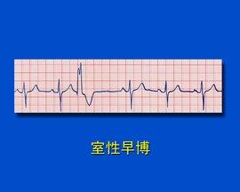 频发室性早搏