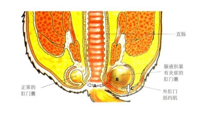 肛门脓肿