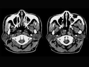 腺样体炎(adenoiditis)是存在于鼻咽腔顶部的淋巴组织的炎症.