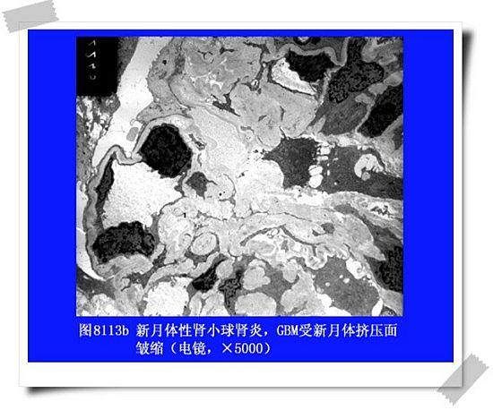 新月体肾小球肾炎