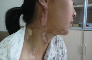 下面王华柱专家领我们看一下女性患者都有什么症状. [2]