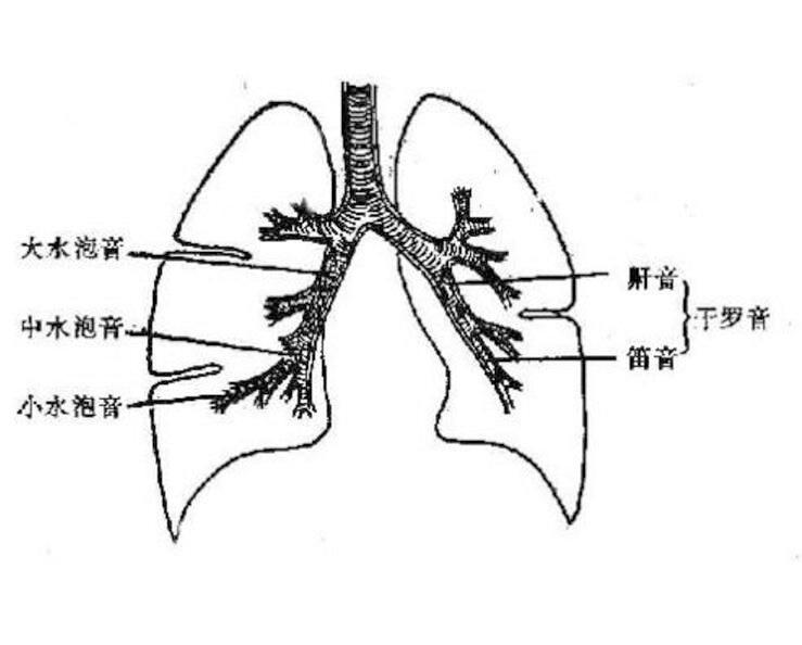 湿啰音是由于吸气时气体通过呼吸道内的分泌物如渗出液,痰液,血液