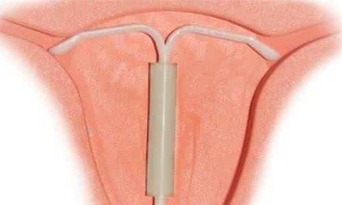 节育器是一种放置在子宫腔内的避孕装置,由于初期使用的装置多是环状