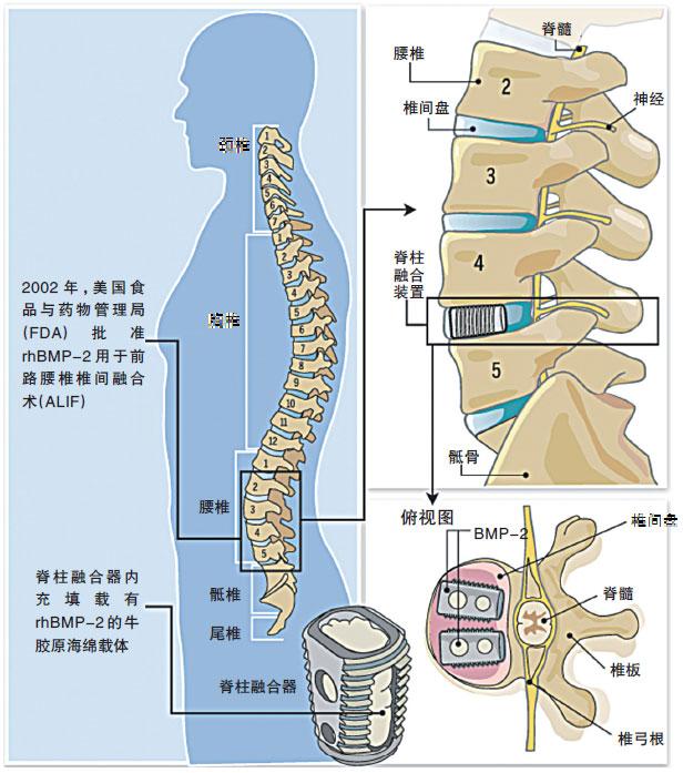 脊柱融合术