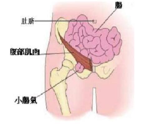 小肠疝气