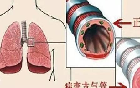 支气管炎