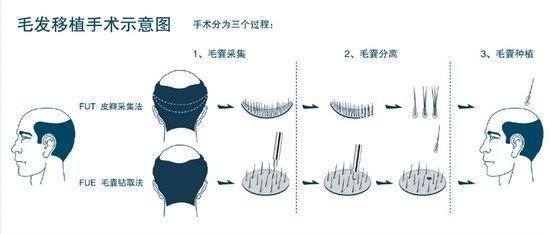 毛囊种植