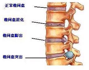 椎间盘膨出