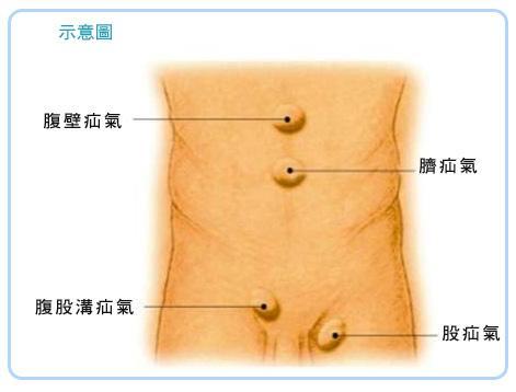 以修补缺损的手术;由于外科常见的疝气分为腹股沟疝气(多由于肌肉筋膜