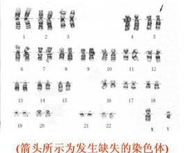 猫叫综合征,患者第5号染色体短臂缺失,故又名5p—综合征,为最常见的
