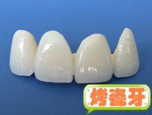 烤瓷牙,即烤瓷熔附金属全冠又称金属烤瓷联合冠(metal-ceramic crown