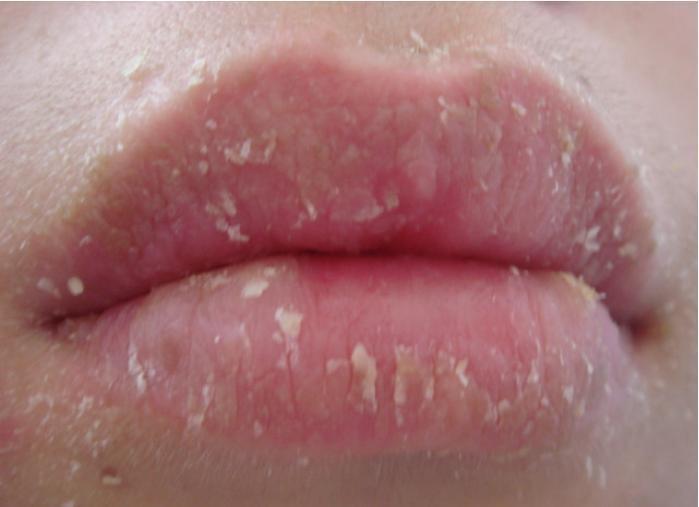 干燥脱屑型唇炎[1]又名单纯性唇炎或剥脱性唇炎,是唇黏膜的一种慢性浅