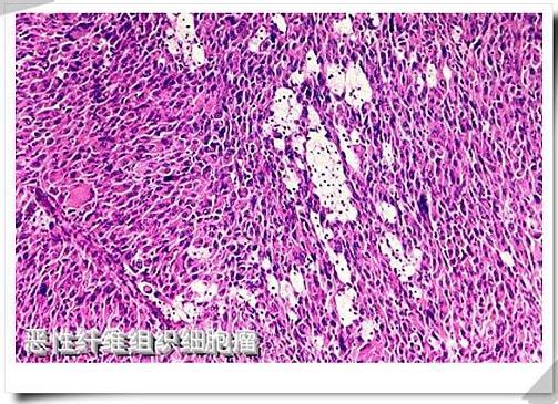恶性纤维组织细胞瘤