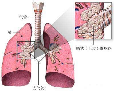 肺癌