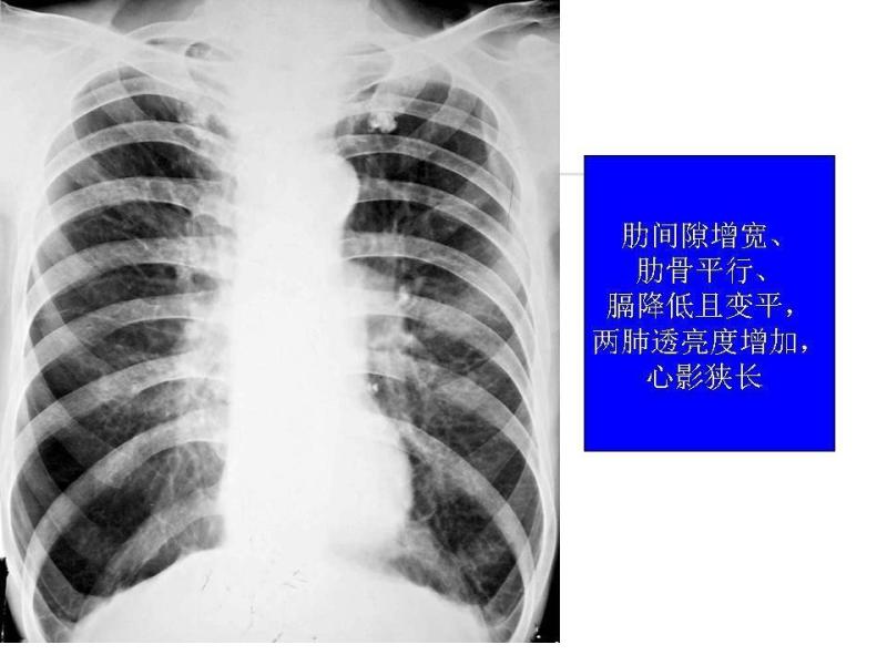 病情进展,常常并发肺气肿和慢性肺源性心脏病.