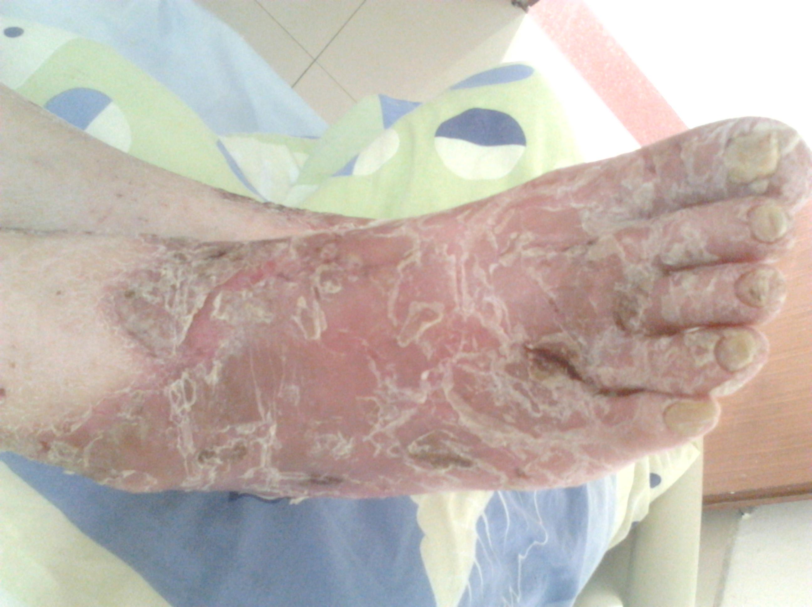 皮肤真菌感染的一些常见的病症是体癣,脚癣及皮肤念珠菌病