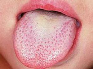 杨梅舌是由于某些充血性疾病引起的舌乳头充血水肿,突